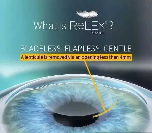 RELEX SMILE LASER EYE SURGERY