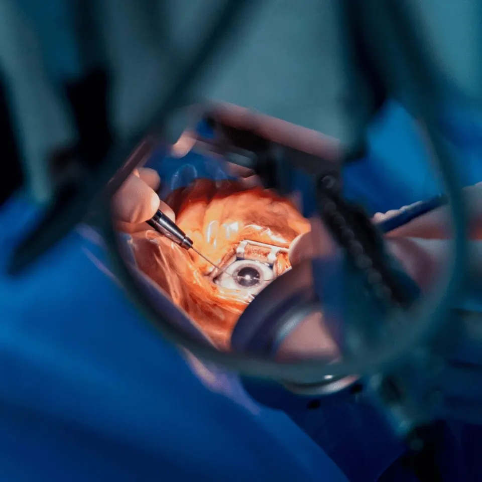 cataract surgery recovery timeline