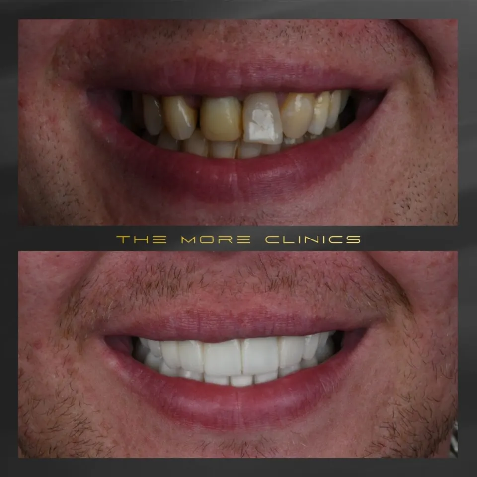 vorher nachher veneers schiefe zähne