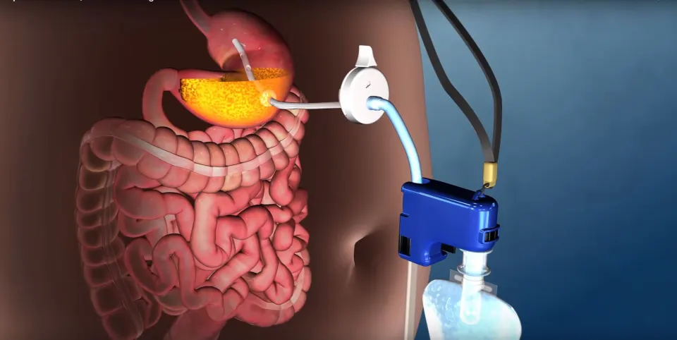 aspire assist for non surgical weight-loss