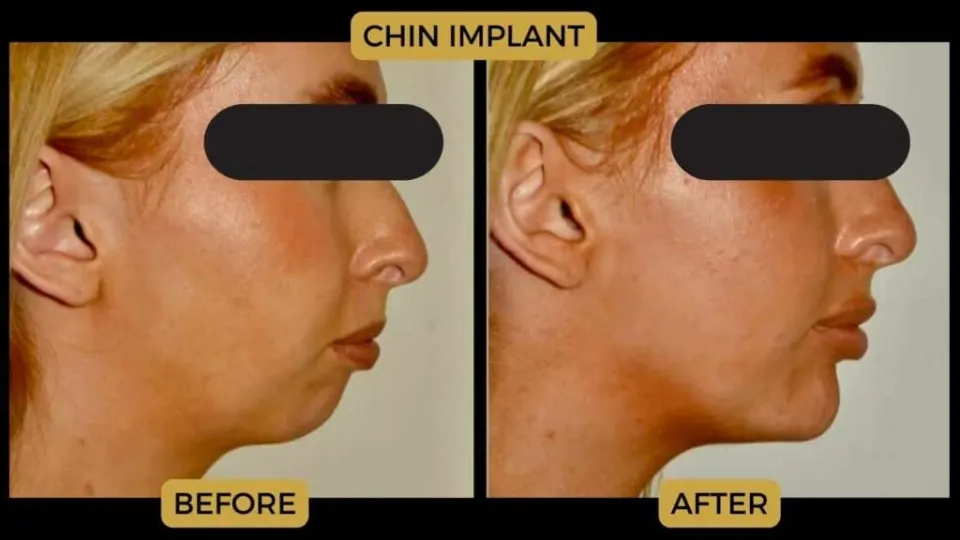 chin implant before after