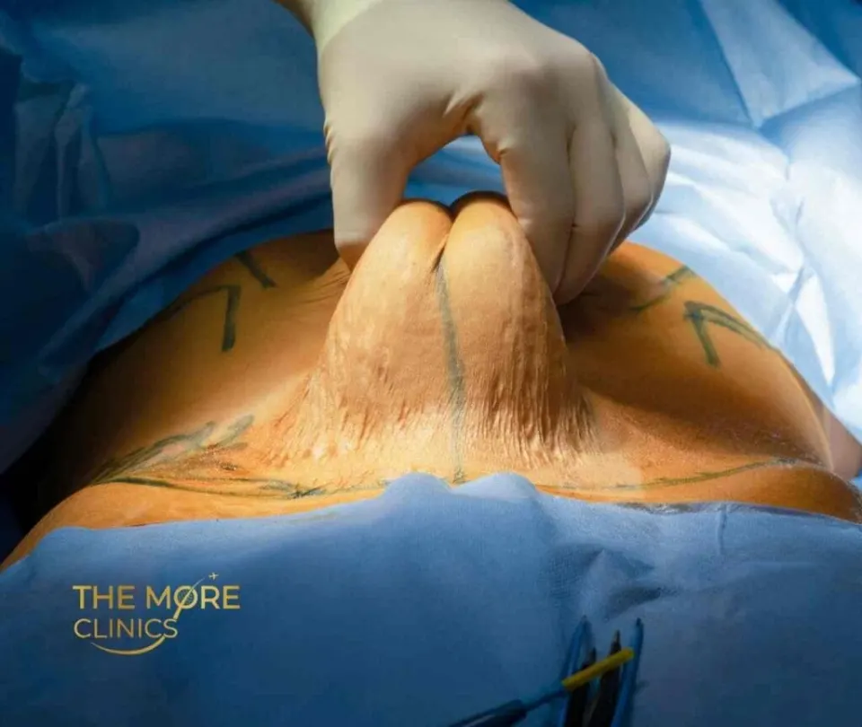 abdominoplastik türkei