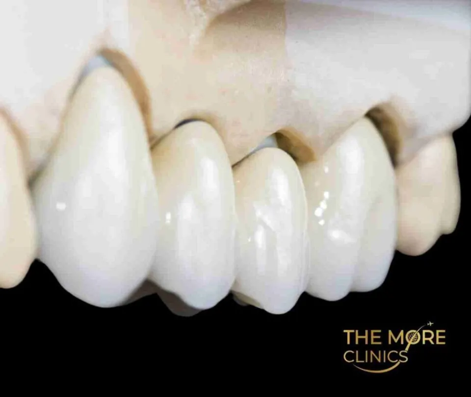 Dental bridge replacing a missing tooth — pontic anchored to adjacent crowns