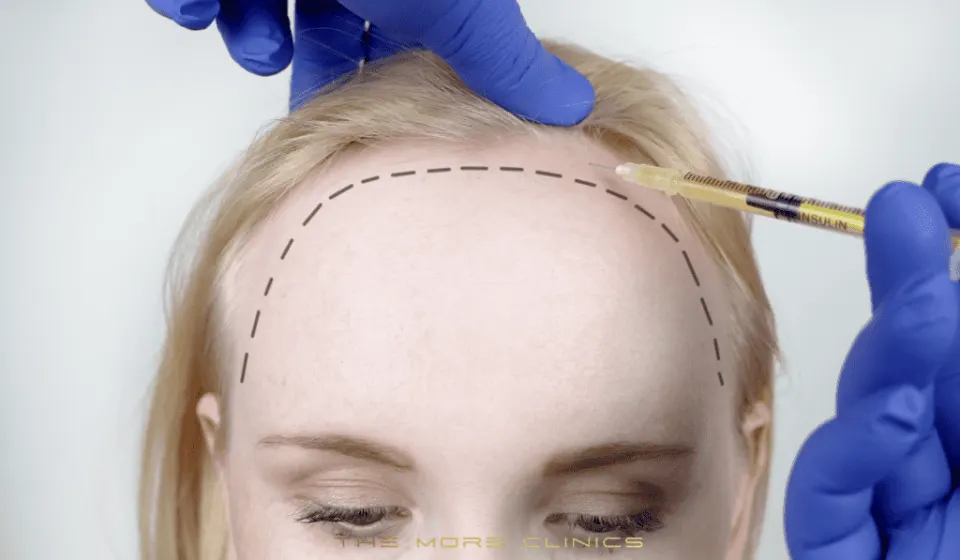 Haartransplantation bei Frauen