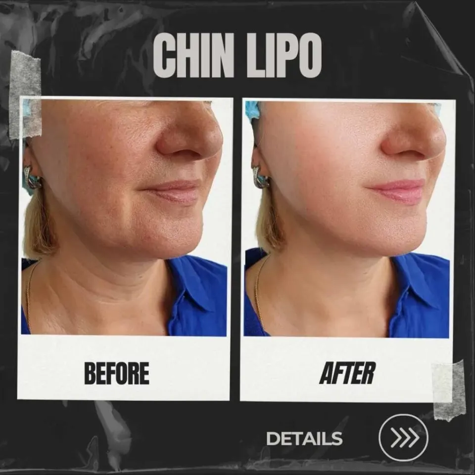 turkey neck chin liposuction before and after