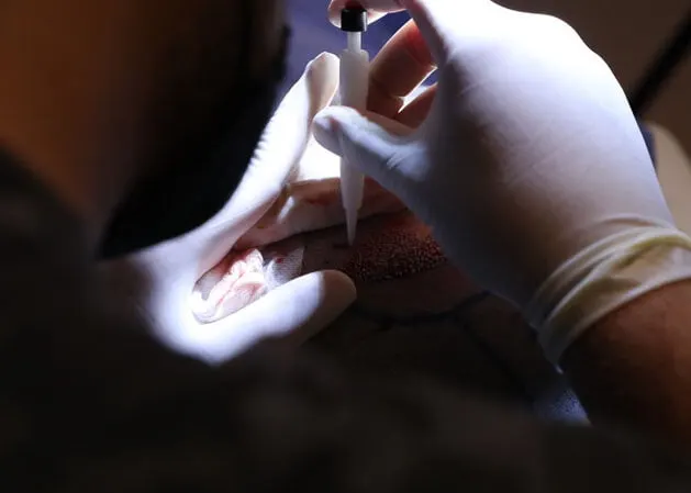 DHI oder FUE Haartransplantation: Welche ist besser für Sie?