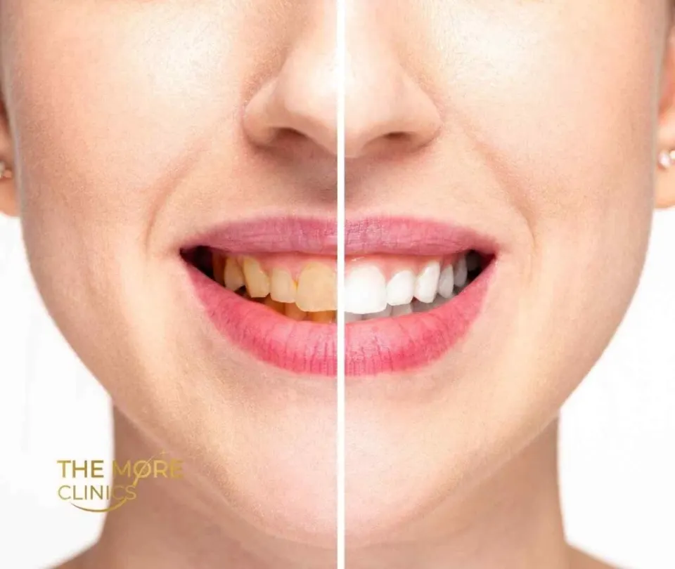 zoom teeth whitening turkey antalya before and after