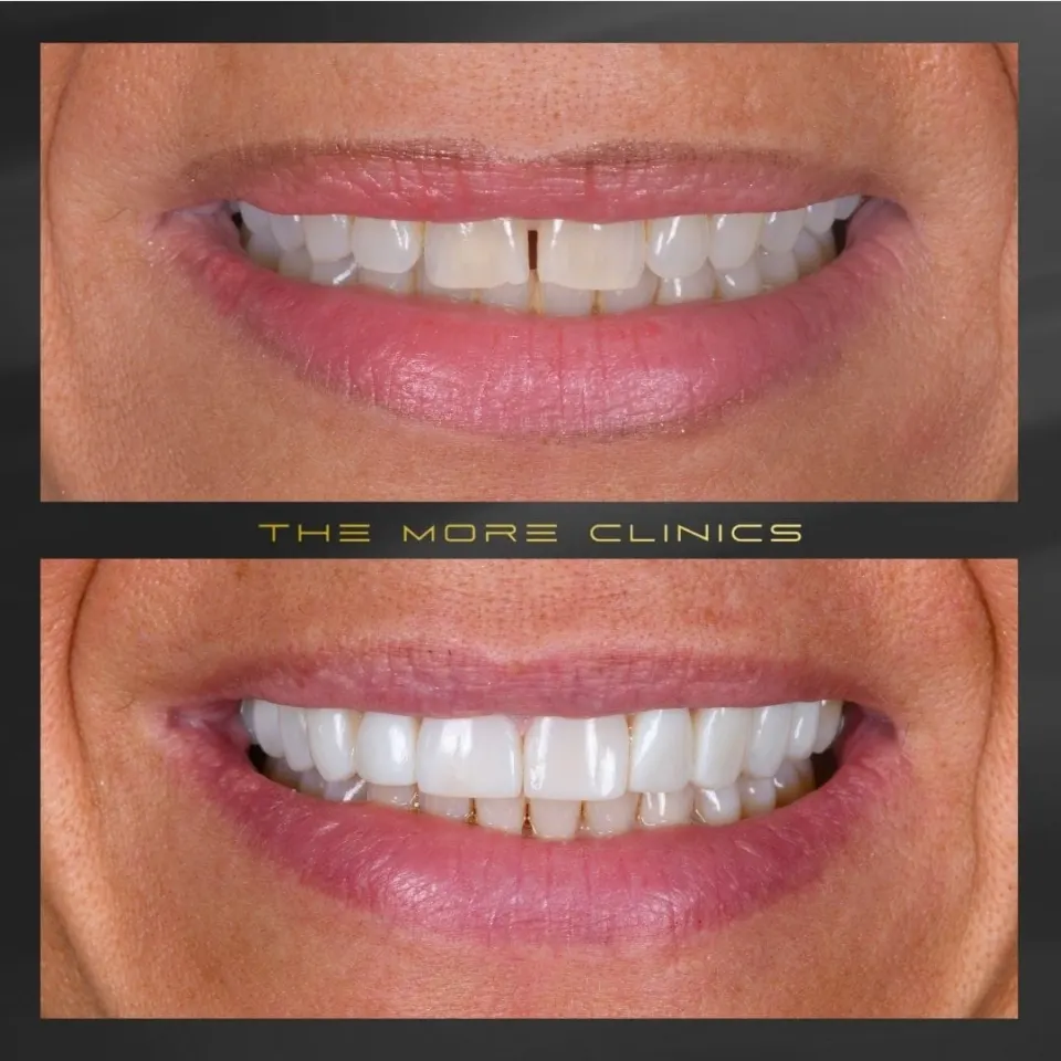 Dental before & after 15
