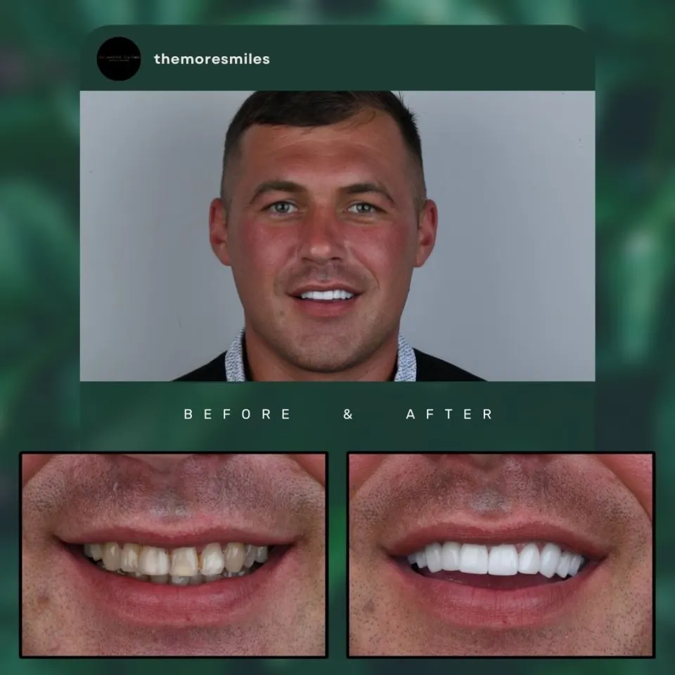 Dental before & after 31