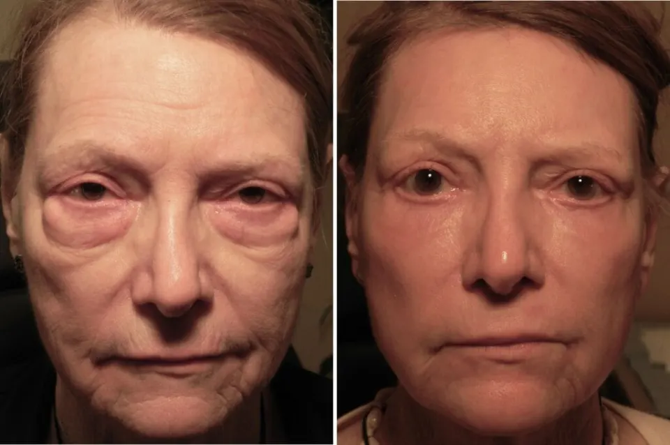 Blepharoplasty before after eyelid surgery Turkey — upper and lower