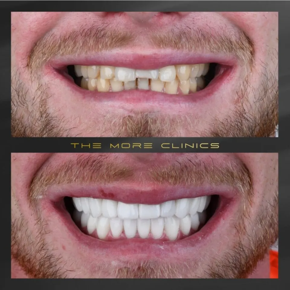 Hollywood Smile avec couronnes dentaires avant et après