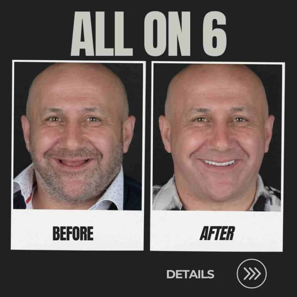 all on 6 turkey implantes dentales antes y después