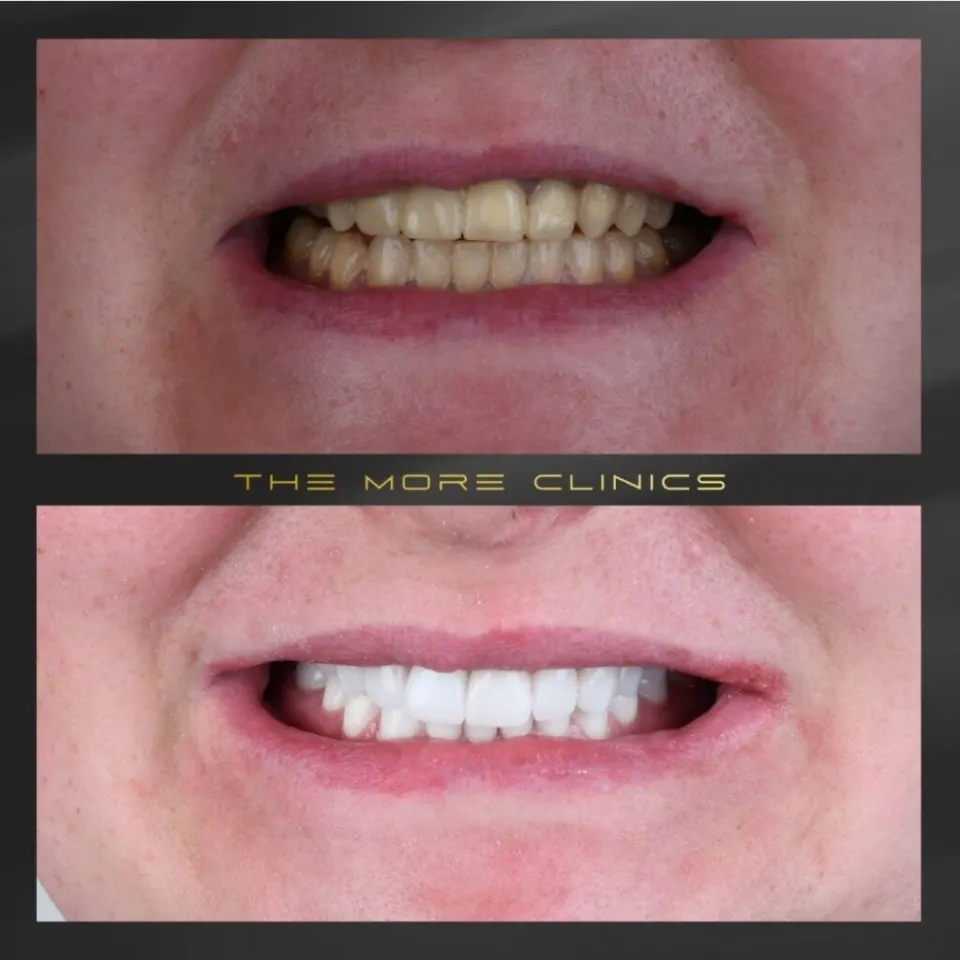 antes y después de carillas dentales turkey