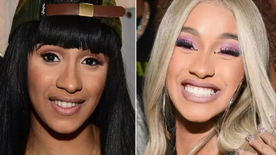 Cardi B Teeth Before and After