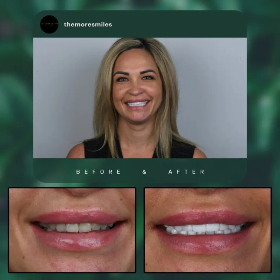 Türkei Veneers Vorher Nachher Bilder — Porzellanveneers Antalya