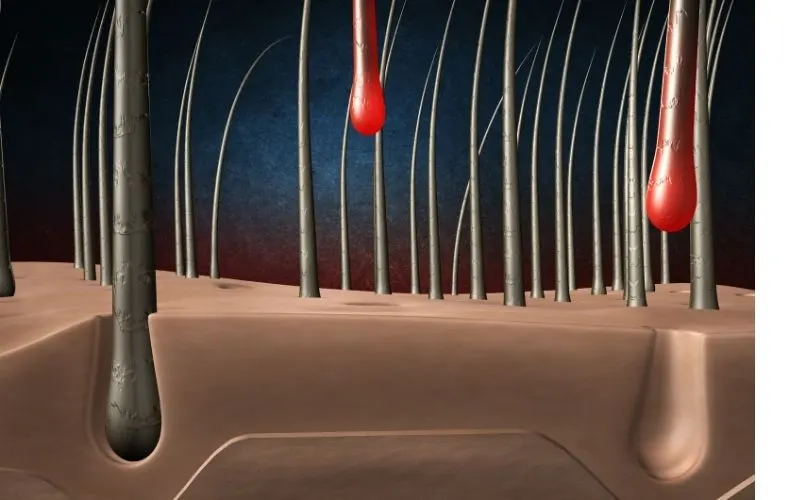 Hair Transplant Turkey
