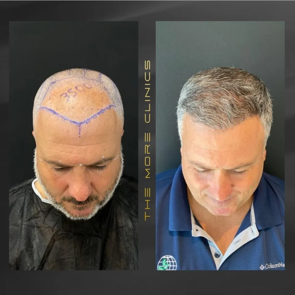 Hair-transplant results 2