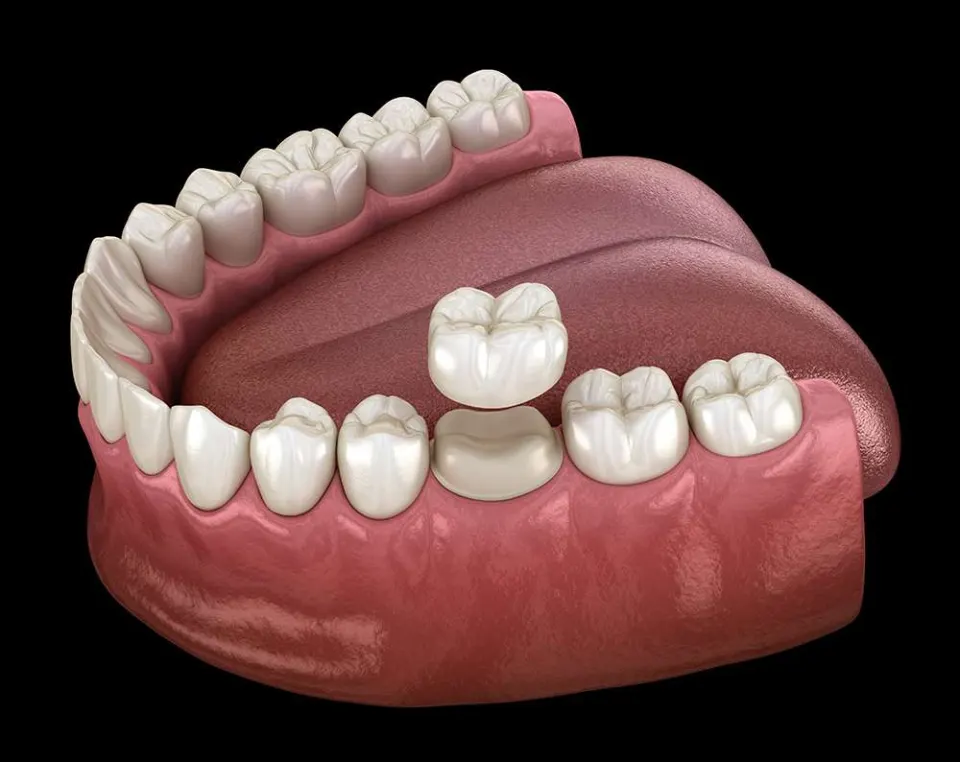 dental crowns in antalya