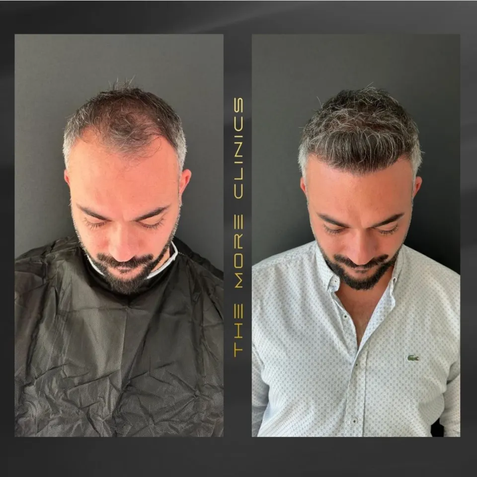 Hair-transplant results 6
