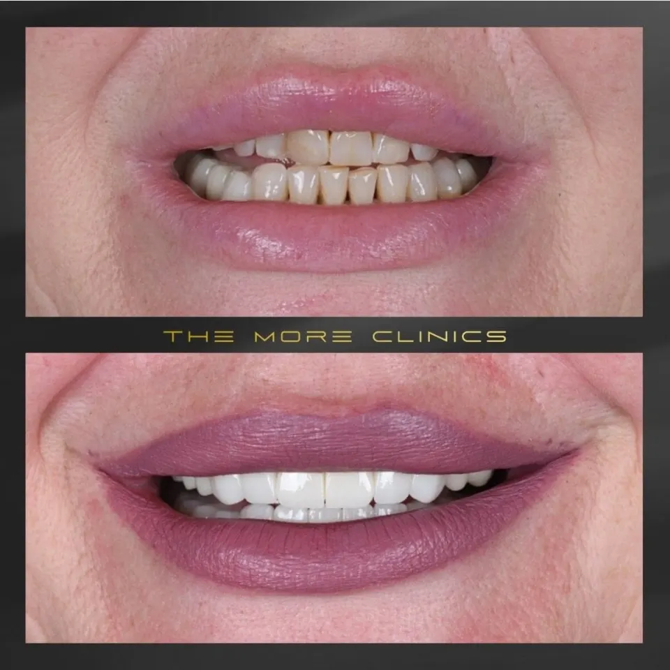 Dental before & after 13