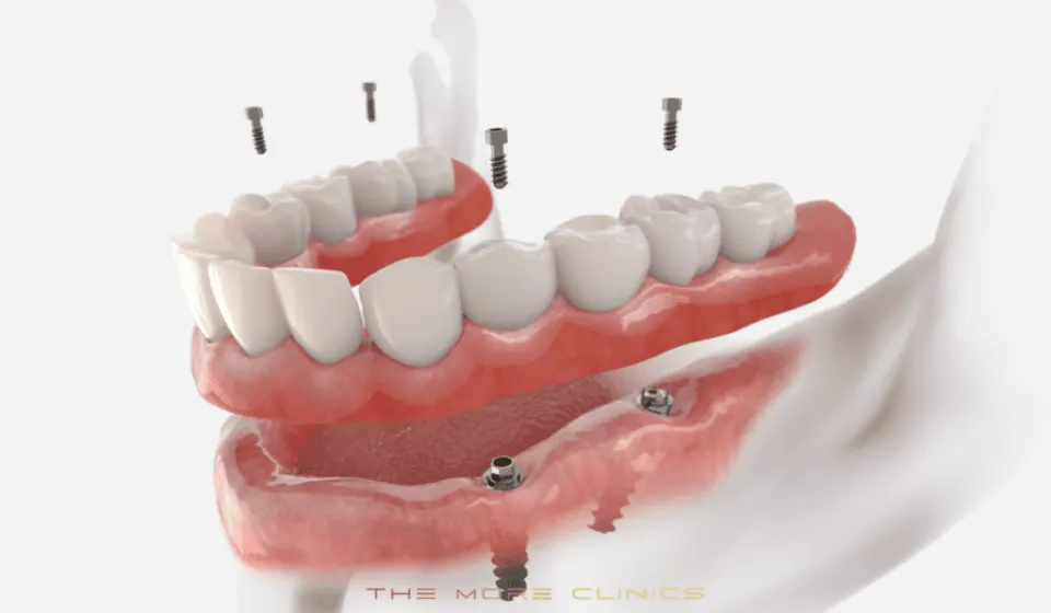 Antalya All on Four Implant