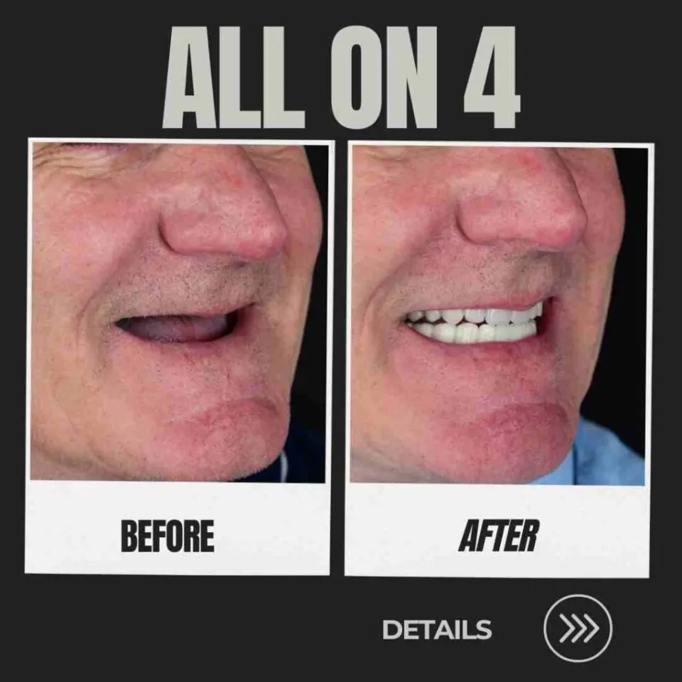 All-on-4 dental implants Turkey before and after — full arch restoration