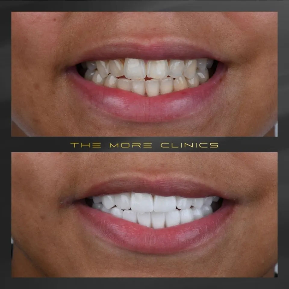 Dental before & after 34