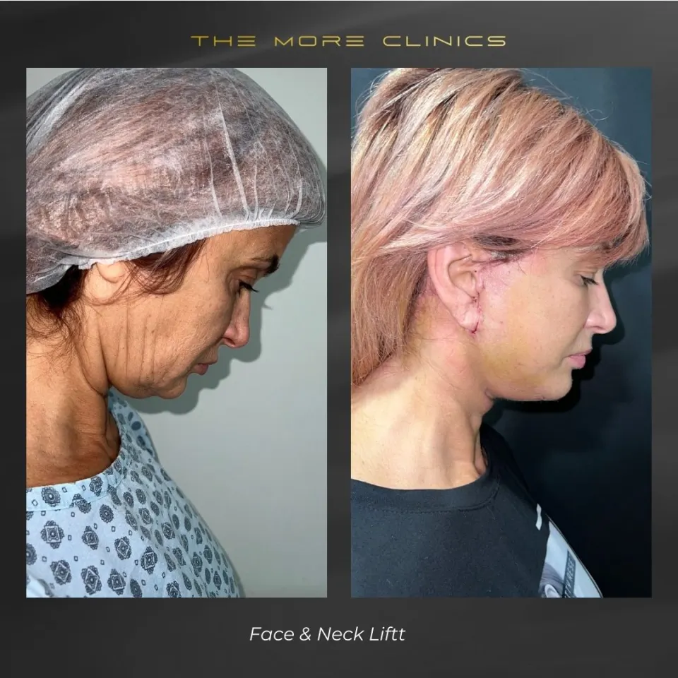 Aesthetic before & after 7