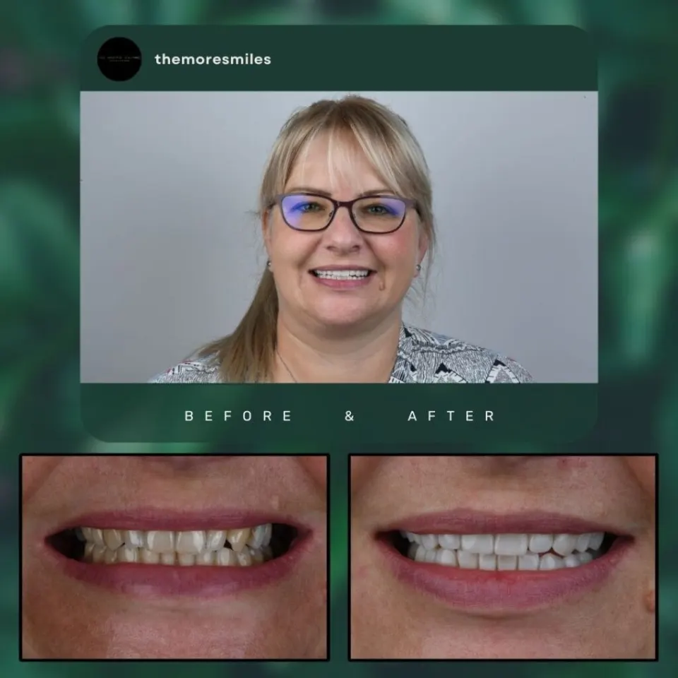 Dental before & after 45