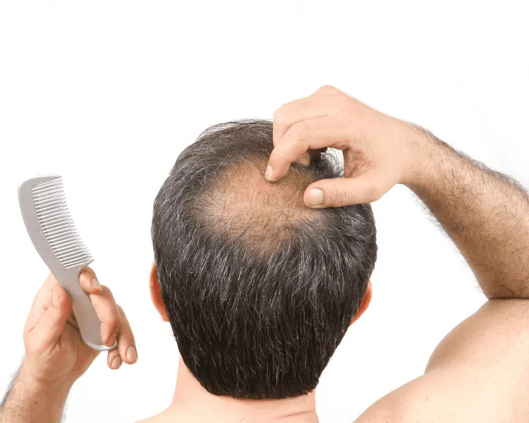 male pattern baldness androgenetic alopecia
