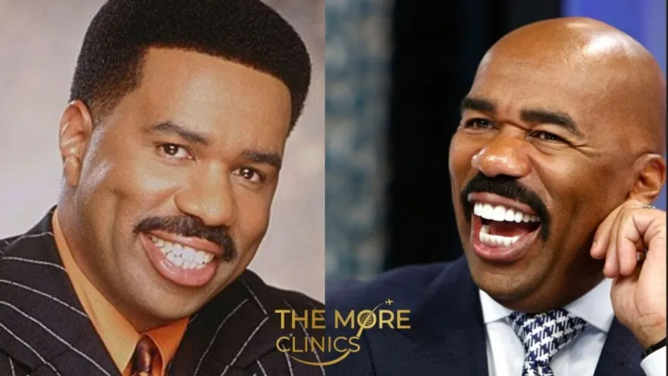 steve harvey teeth before and after