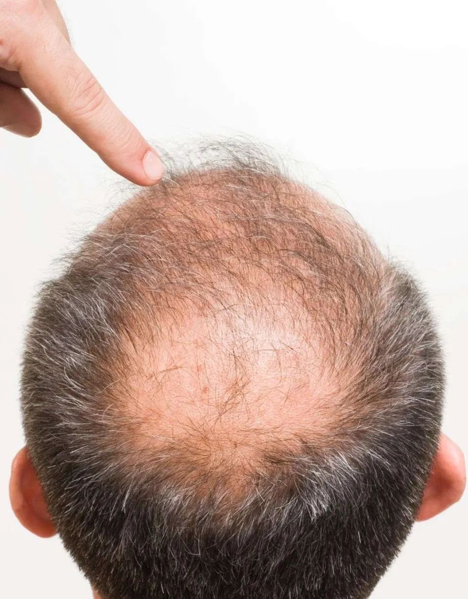 male pattern baldness treatment option : hair transplant