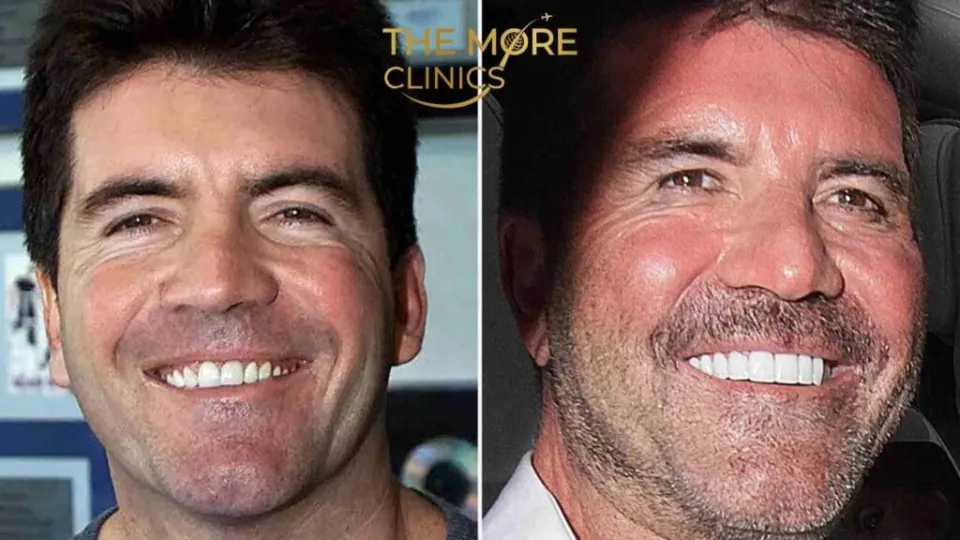 Simon Cowell Veneers Celebrity
