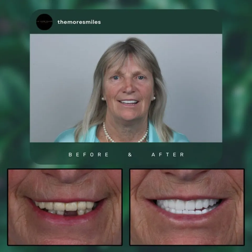 Dental before & after 11