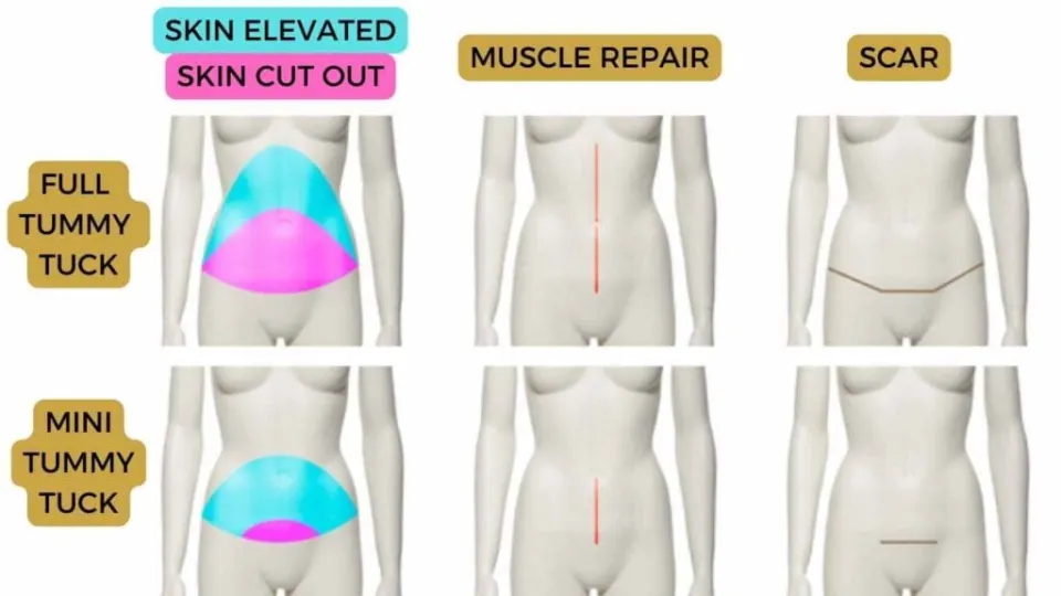Abdominoplastie complète et mini : cicatrices et incisions comparées
