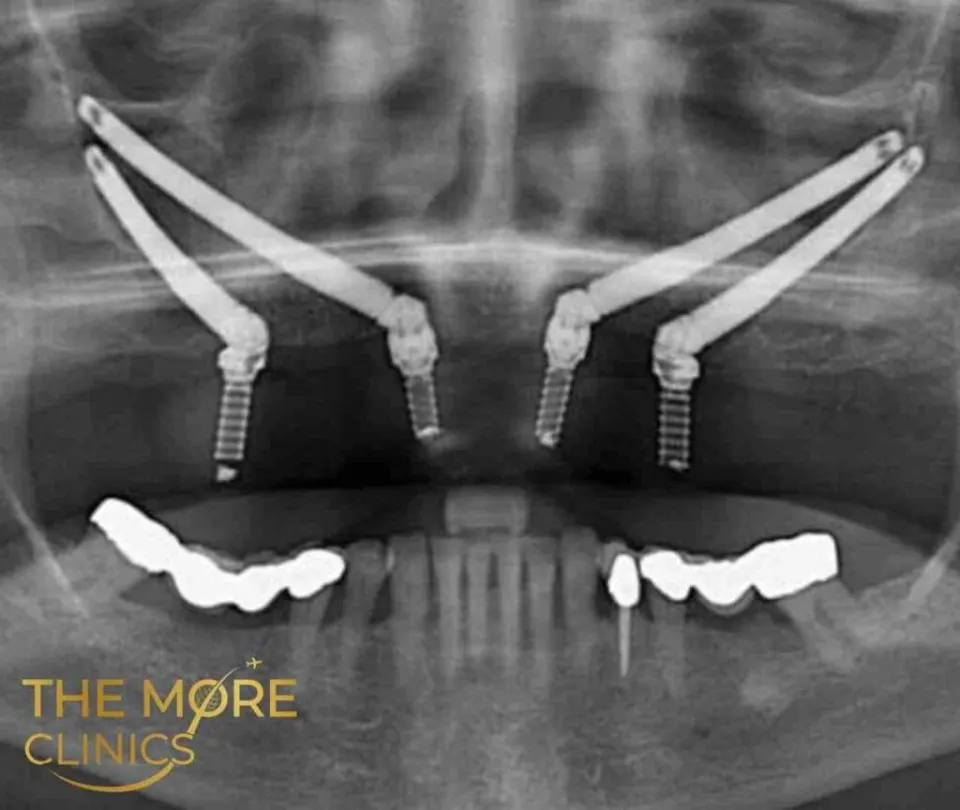 implantes de cigoma antes y después