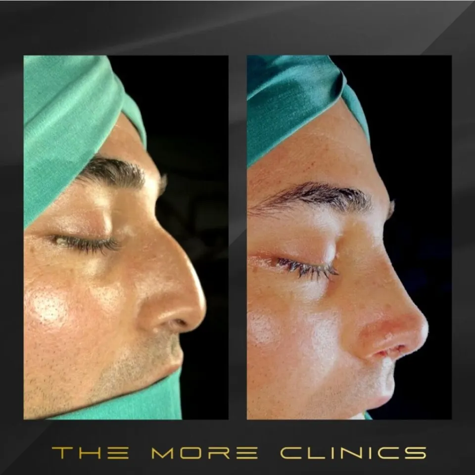 men rhinoplasty before after men's male nose job