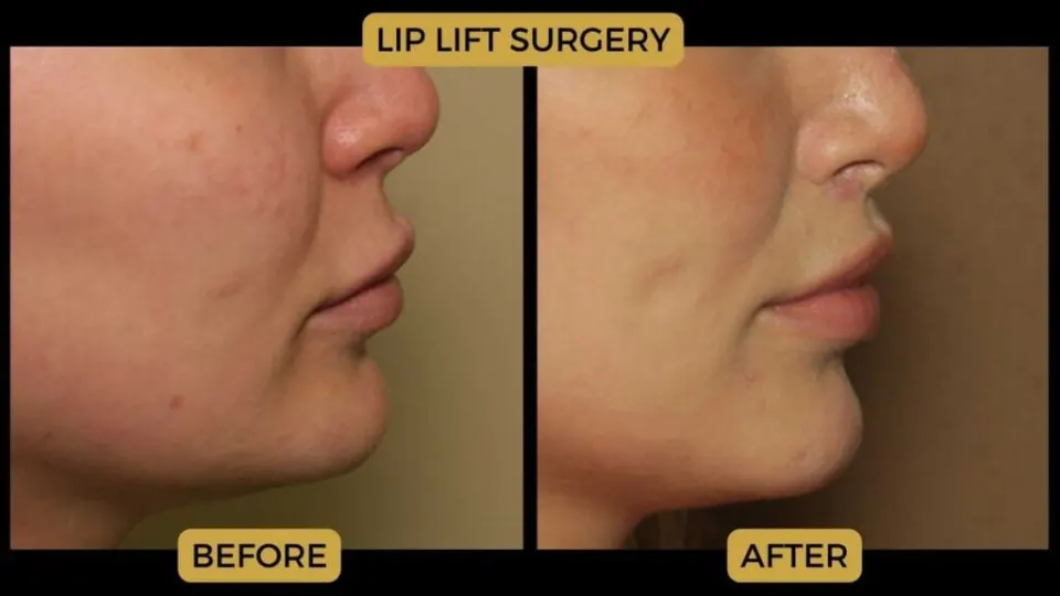 lip lift before and after surgery
