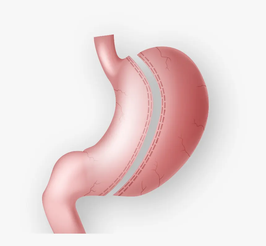 how does sleeve gastrectomy look on stomach