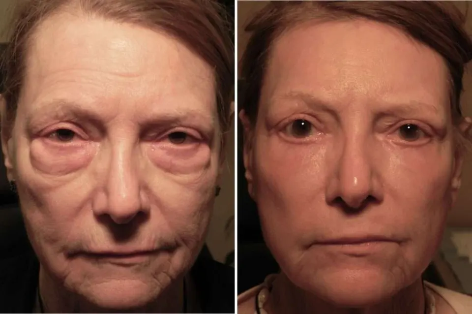 Chirurgie des paupières supérieures avant et après chez une femme d’âge moyen