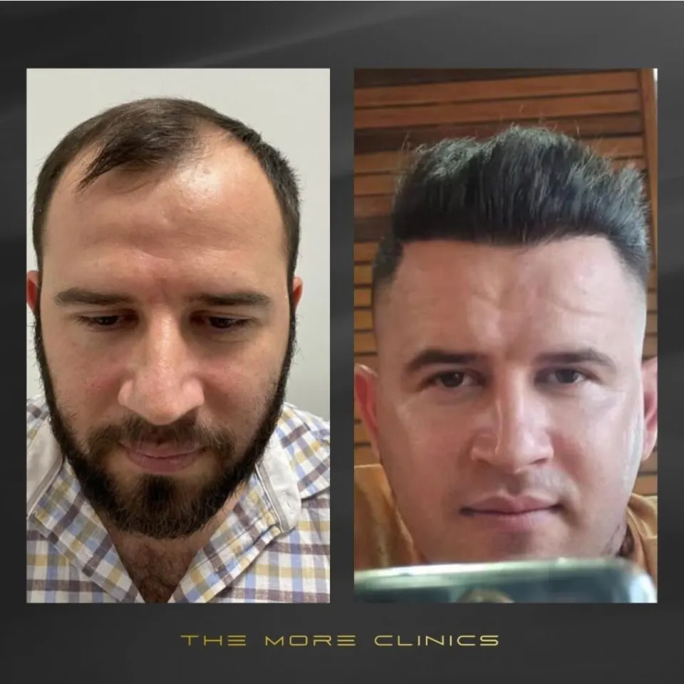 DHI Haartransplantation vorher nachher Türkei Antalya