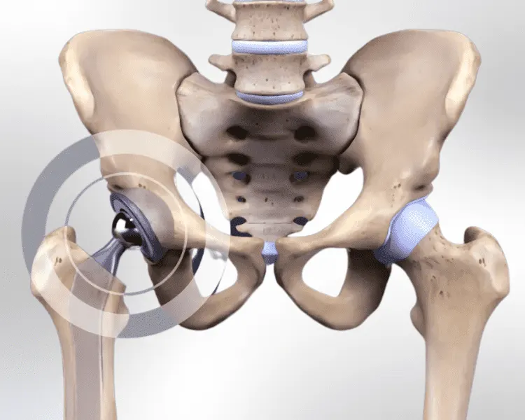 total hip replacement