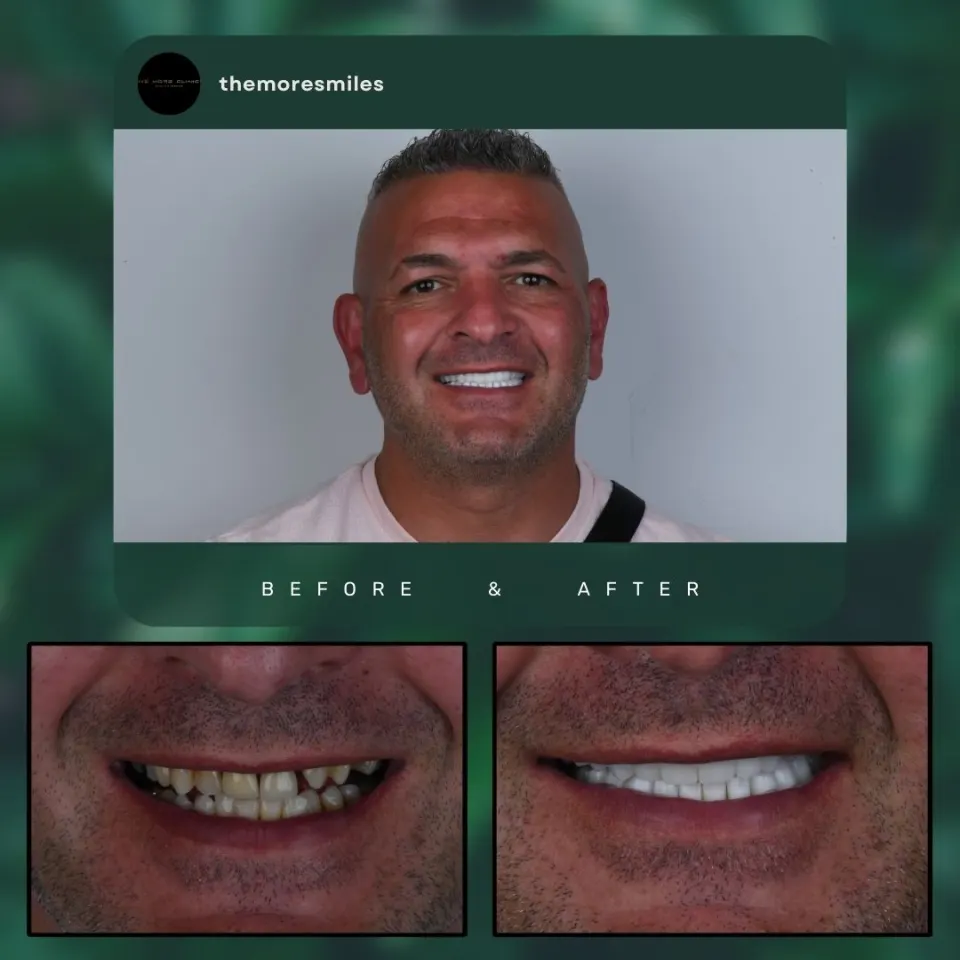 Antalya Dental Veneers