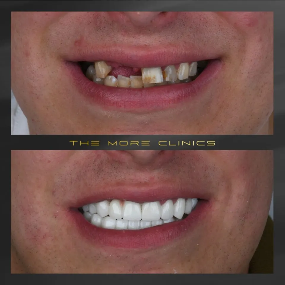 smile makeover before and after with hollywood white