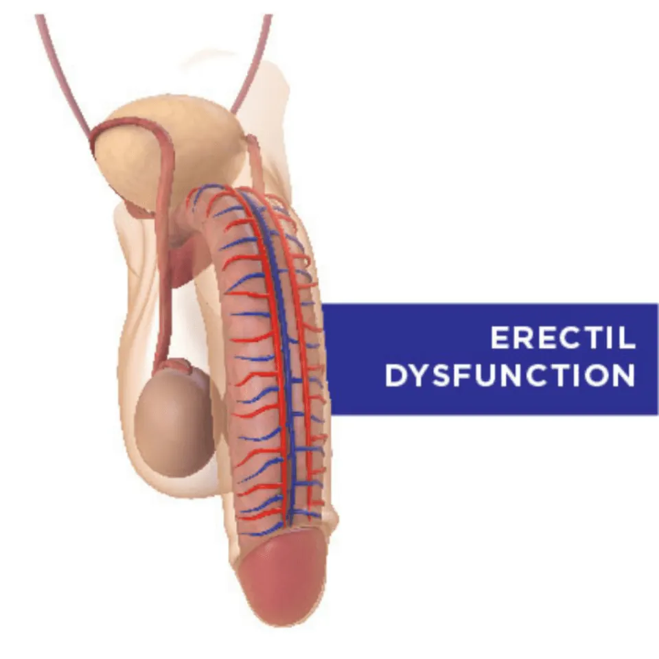 erectile dysfunction symptom non erected penis