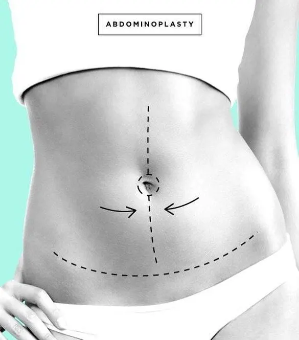 TUMMY TUCK IN ANTALYA