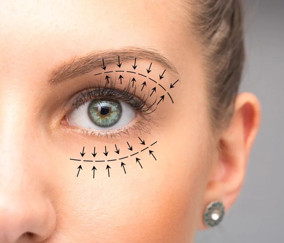 Blépharoplastie et tarifs de la chirurgie des paupières en Turquie