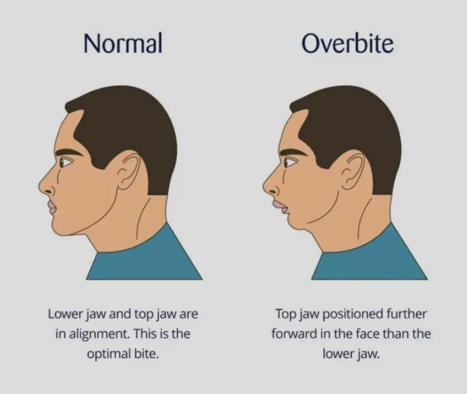 overbite vs normal bite