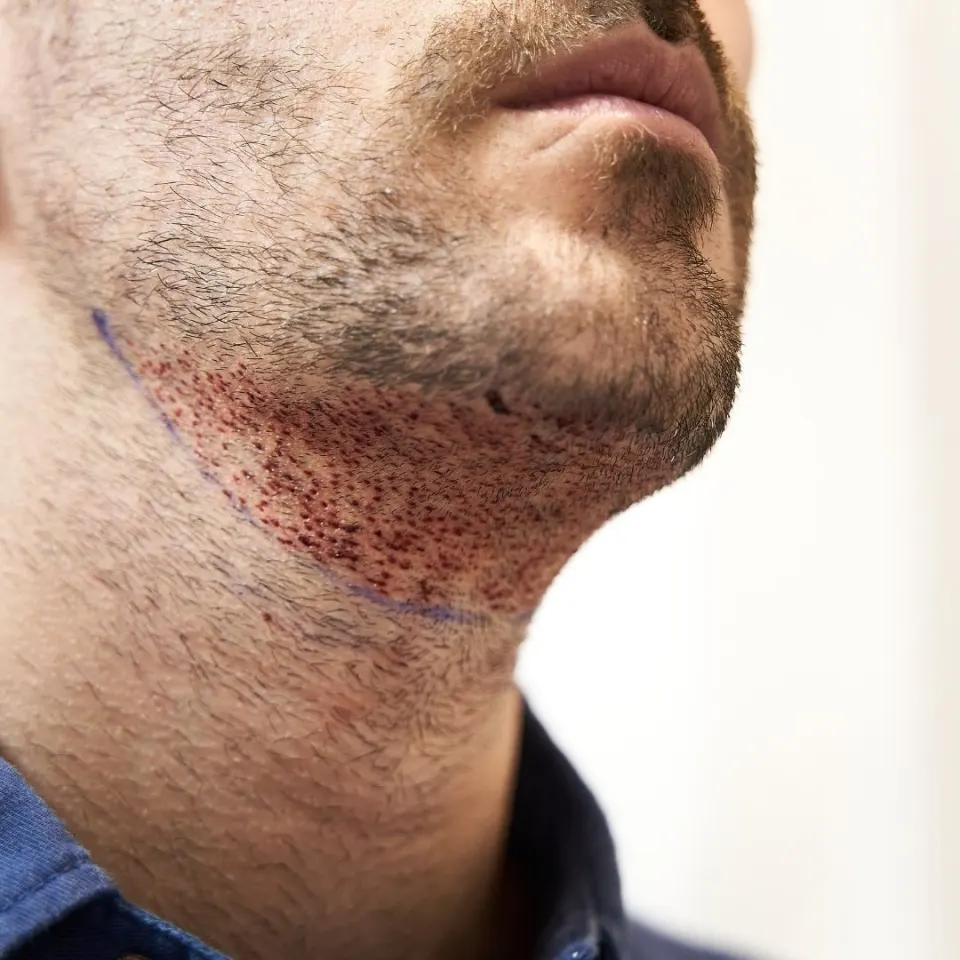 Beard transplant cost 2026 — price per graft, Turkey vs UK and USA