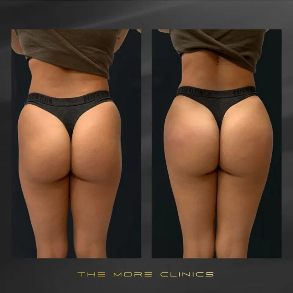 brazilian butt lift before and after